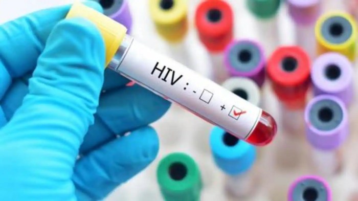 London patient second cured of hiv